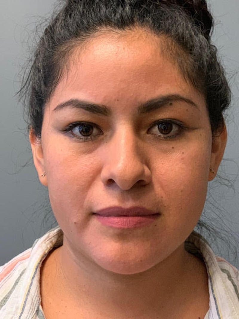 Rhinoplasty Before & After Gallery - Patient 316164 - Image 5