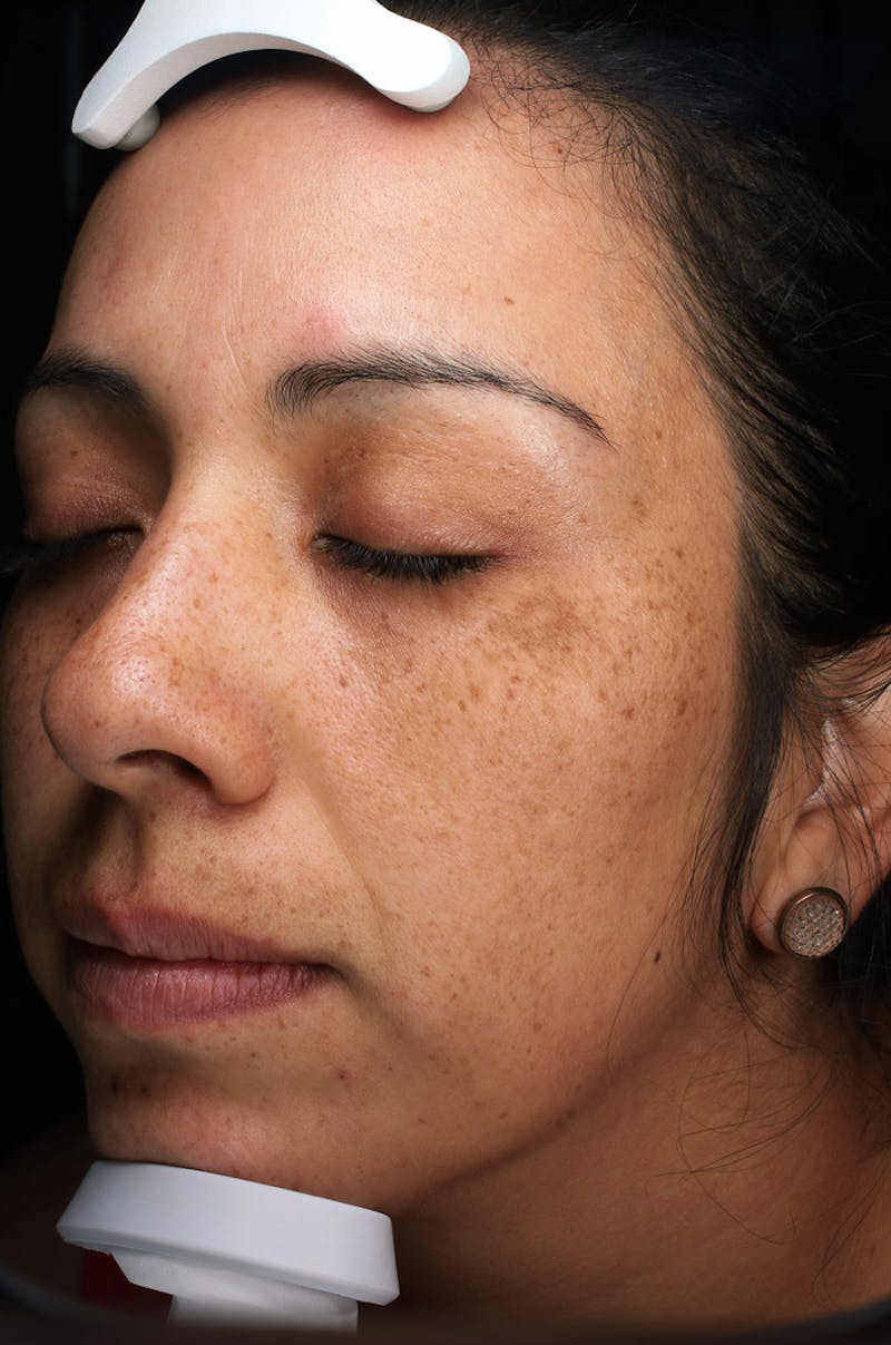 Lasers & Light Before & After Gallery - Patient 108454 - Image 3