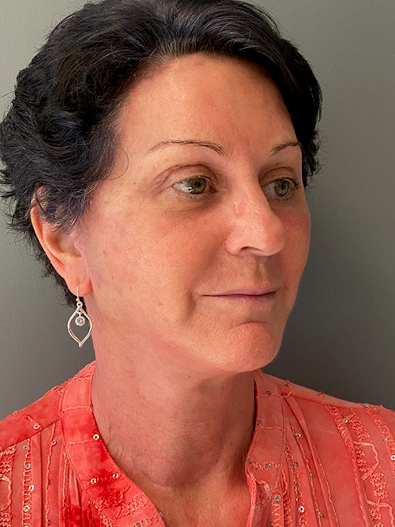 Deep Plane Facelift Before & After Gallery - Patient 643619 - Image 4