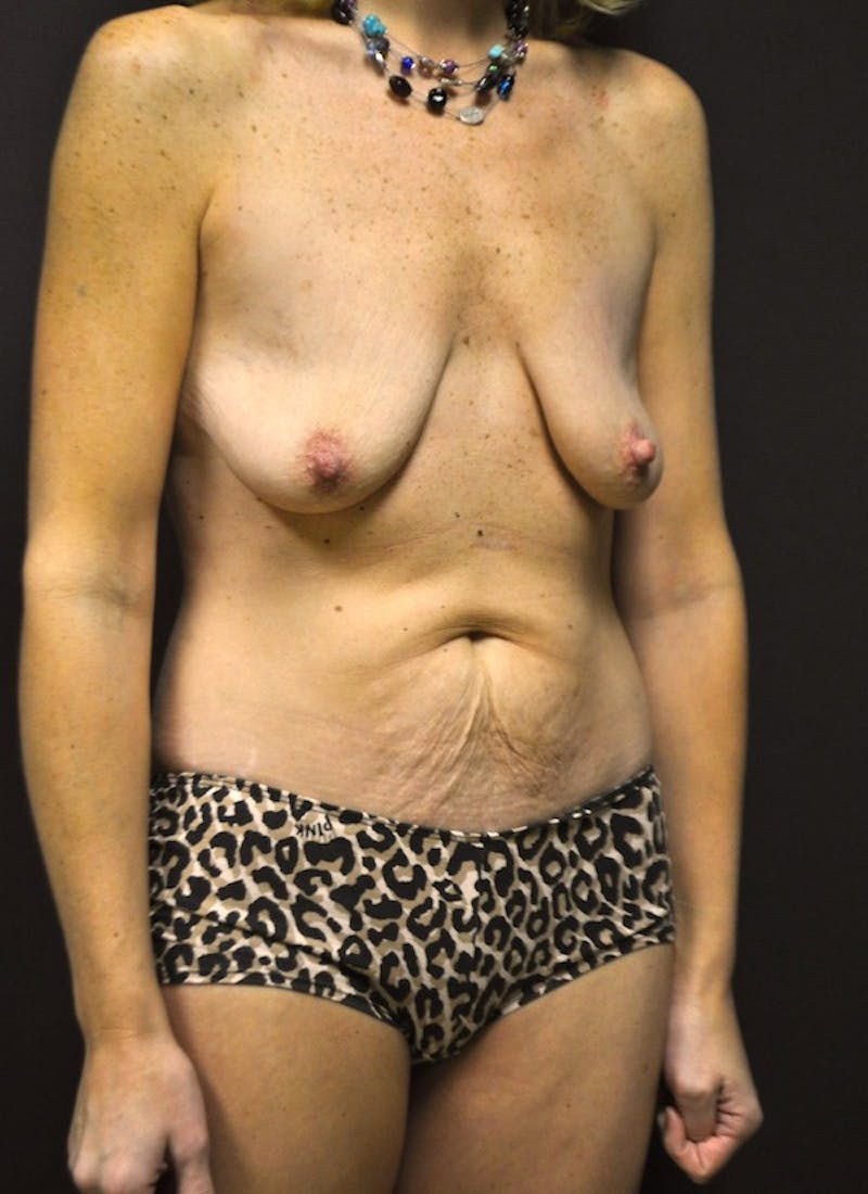 High Definition Mommy Makeover Before & After Gallery - Patient 264019 - Image 3