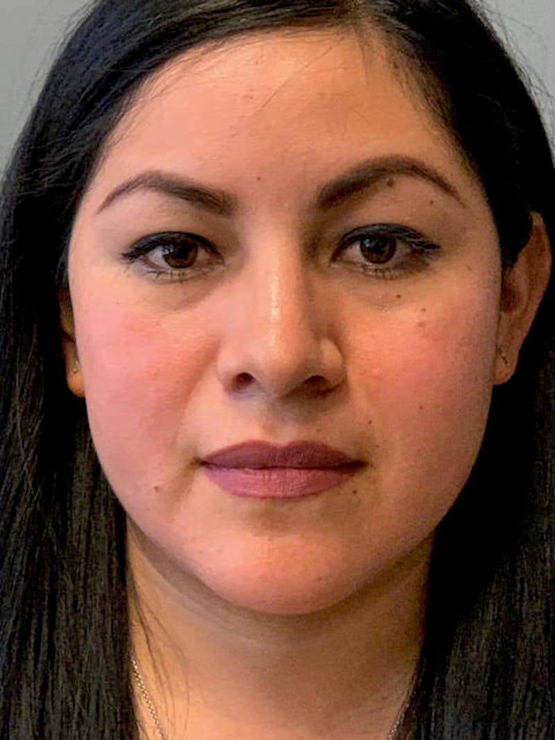 Rhinoplasty Before & After Gallery - Patient 316164 - Image 6