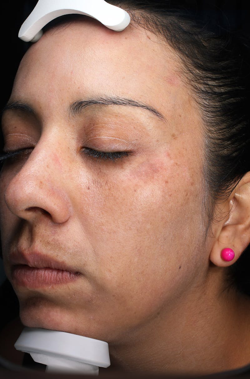 Lasers & Light Before & After Gallery - Patient 108454 - Image 4