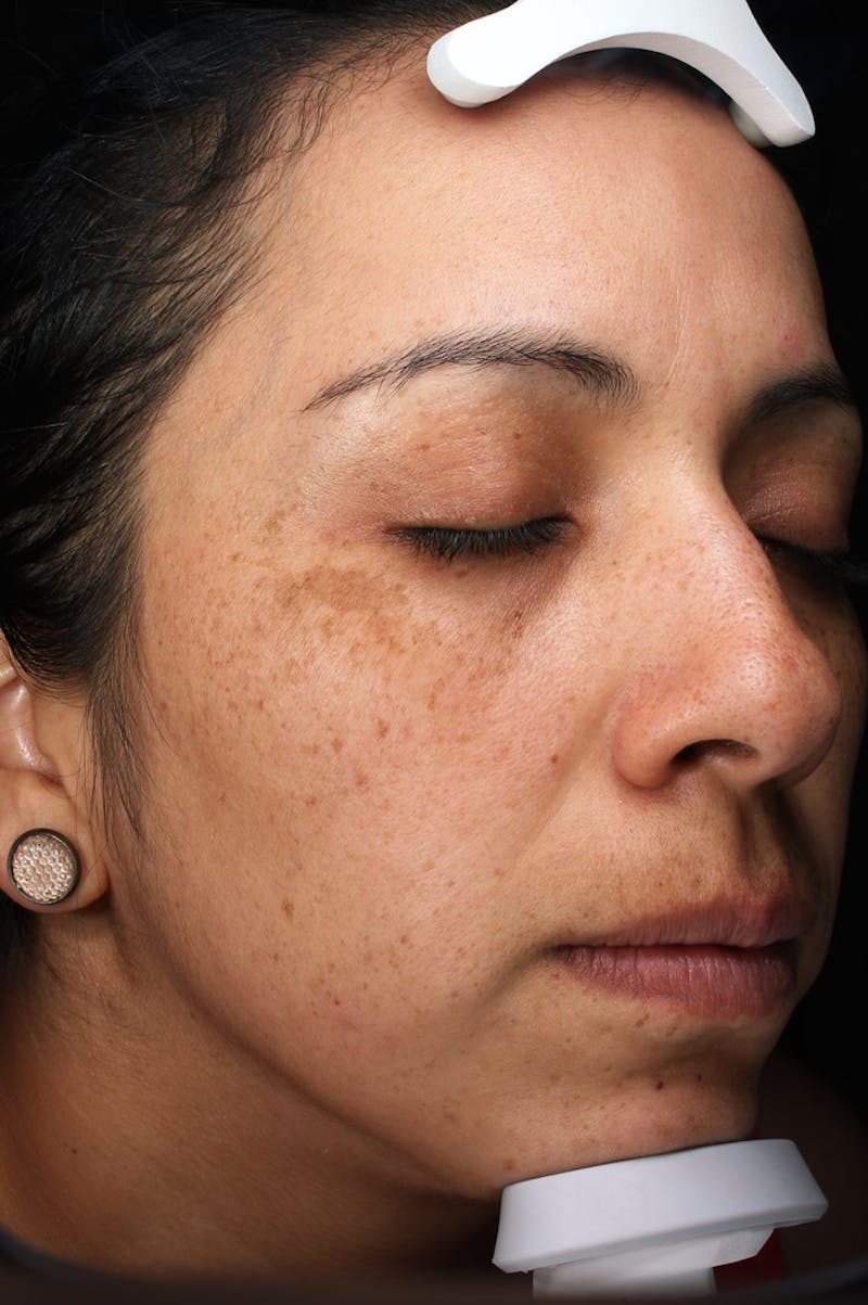 Lasers & Light Before & After Gallery - Patient 108454 - Image 5