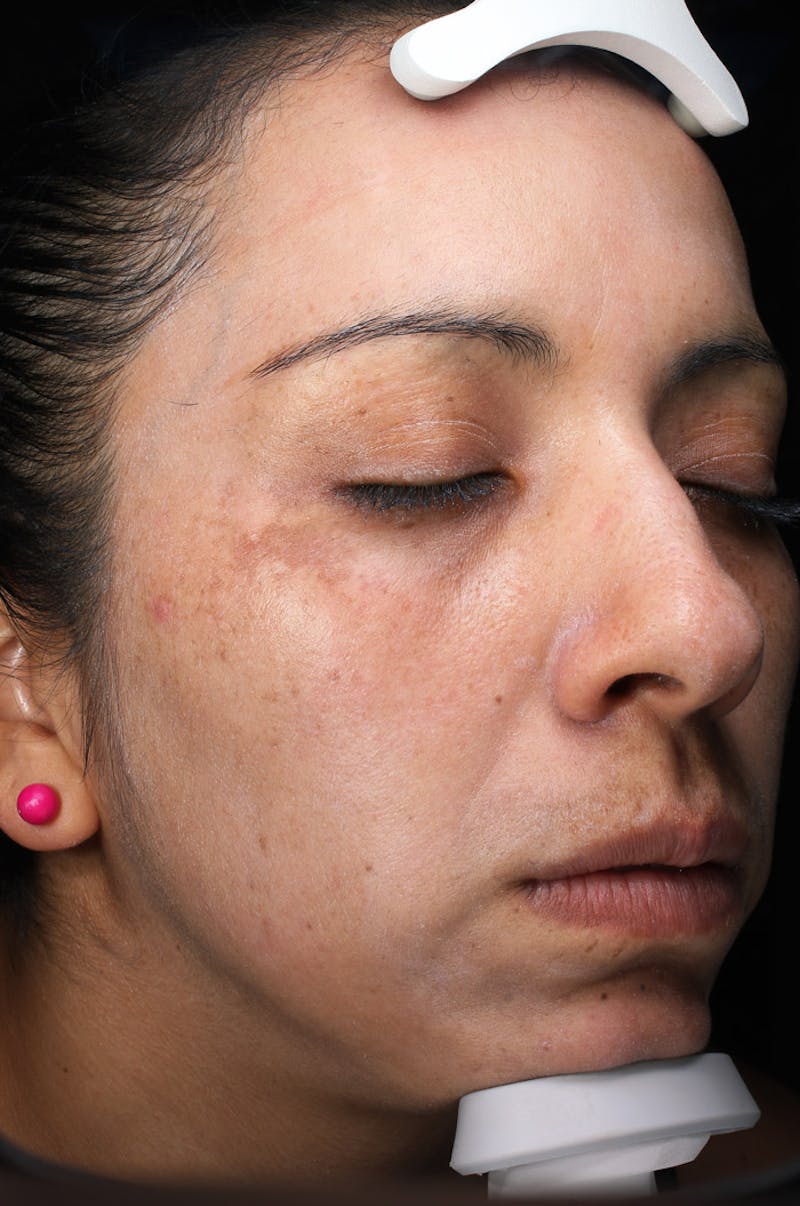 Lasers & Light Before & After Gallery - Patient 108454 - Image 6