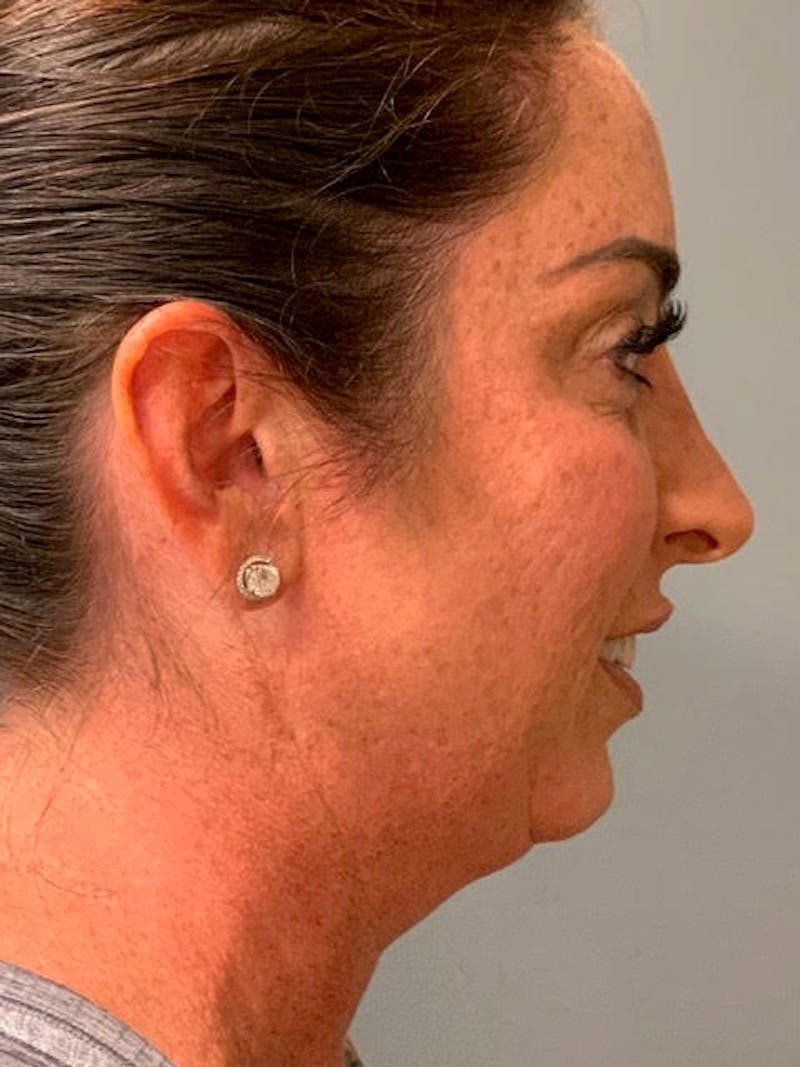 Rhinoplasty Before & After Gallery - Patient 174277 - Image 3