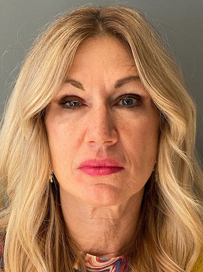 Deep Plane Facelift Before & After Gallery - Patient 292164 - Image 1