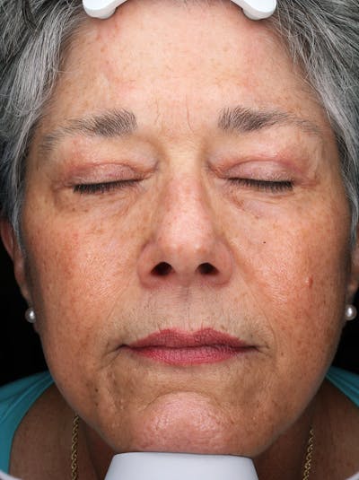 Lasers & Light Before & After Gallery - Patient 159001 - Image 1