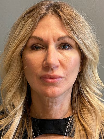 Deep Plane Facelift Before & After Gallery - Patient 292164 - Image 2