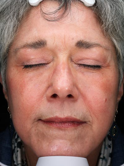 Lasers & Light Before & After Gallery - Patient 159001 - Image 2