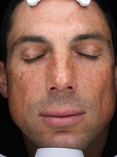 Lasers & Light Before & After Gallery - Patient 158700 - Image 1