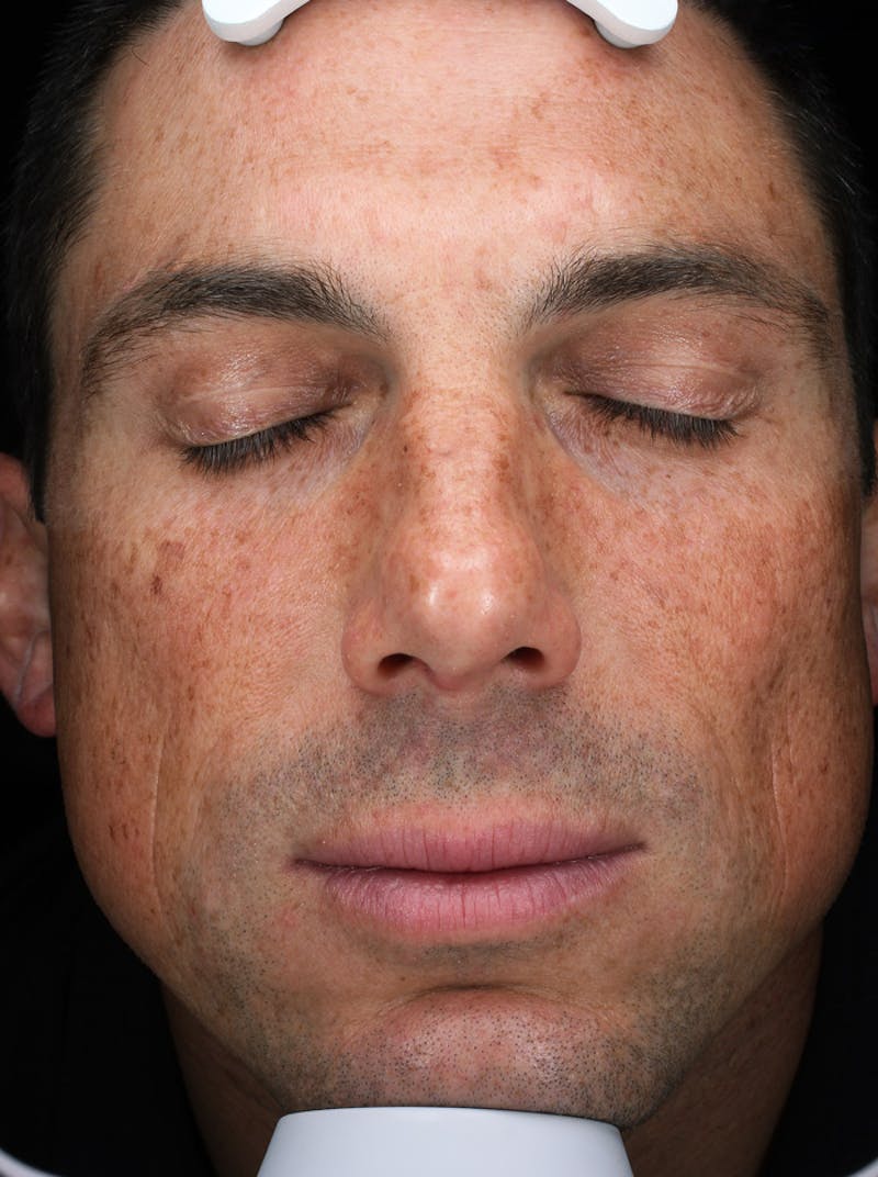 Lasers & Light Before & After Gallery - Patient 158700 - Image 1