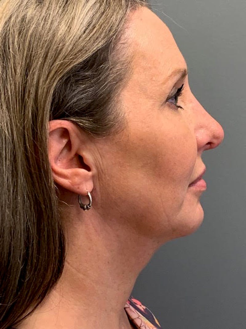 Rhinoplasty Before & After Gallery - Patient 174277 - Image 6