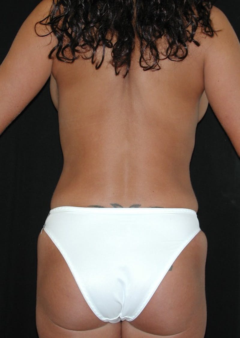 High Definition Mommy Makeover Before & After Gallery - Patient 269804 - Image 6