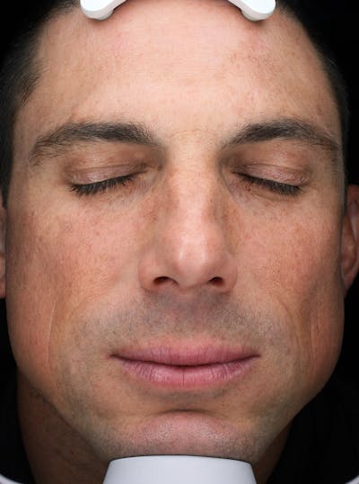 Lasers & Light Before & After Gallery - Patient 158700 - Image 2
