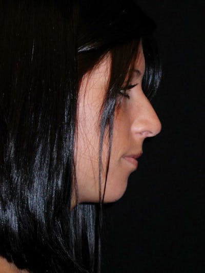Rhinoplasty Before & After Gallery - Patient 100682 - Image 1