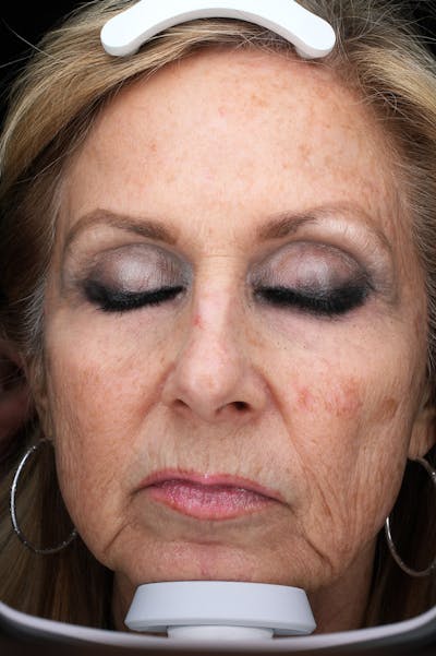 Lasers & Light Before & After Gallery - Patient 691946 - Image 1