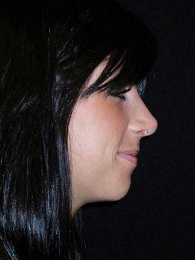 Rhinoplasty Before & After Gallery - Patient 100682 - Image 2