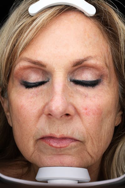 Lasers & Light Before & After Gallery - Patient 691946 - Image 2