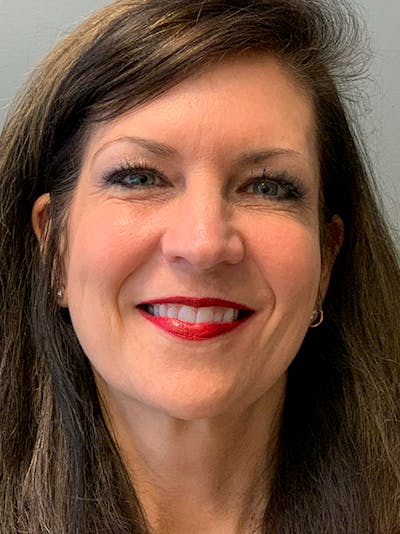 Deep Plane Facelift Before & After Gallery - Patient 260451 - Image 1