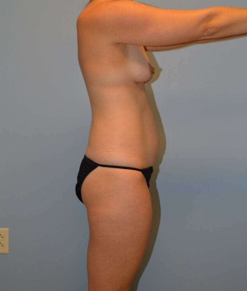 High Definition Mommy Makeover Before & After Gallery - Patient 239821 - Image 3