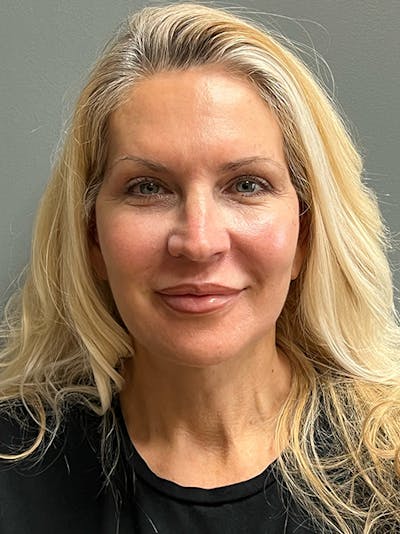Deep Plane Facelift Before & After Gallery - Patient 260451 - Image 2