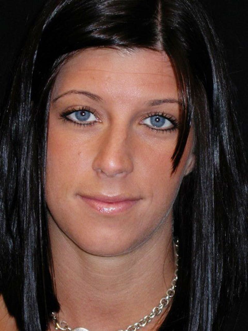 Rhinoplasty Before & After Gallery - Patient 100682 - Image 5