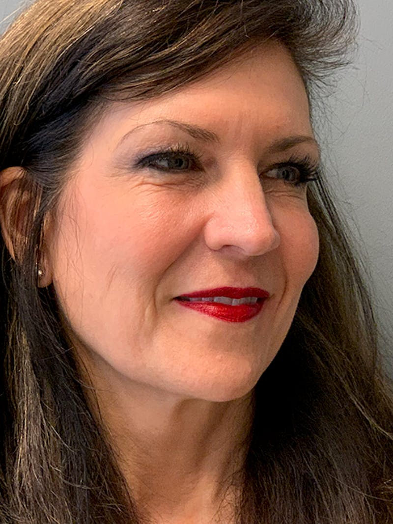 Deep Plane Facelift Before & After Gallery - Patient 260451 - Image 3