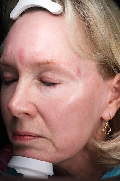 Lasers & Light Before & After Gallery - Patient 123276 - Image 1