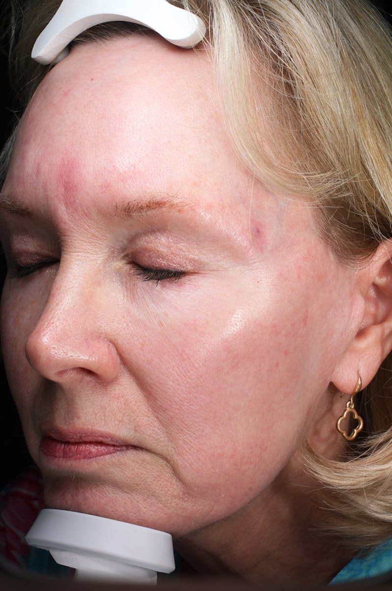 Lasers & Light Before & After Gallery - Patient 123276 - Image 1