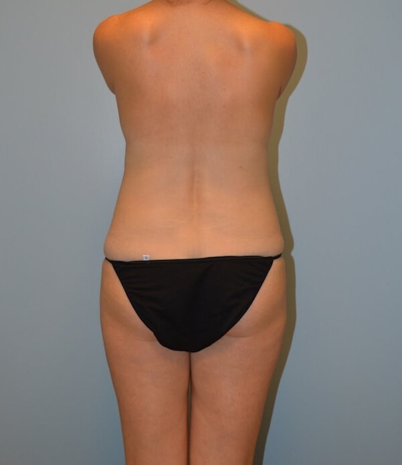 High Definition Mommy Makeover Before & After Gallery - Patient 239821 - Image 5