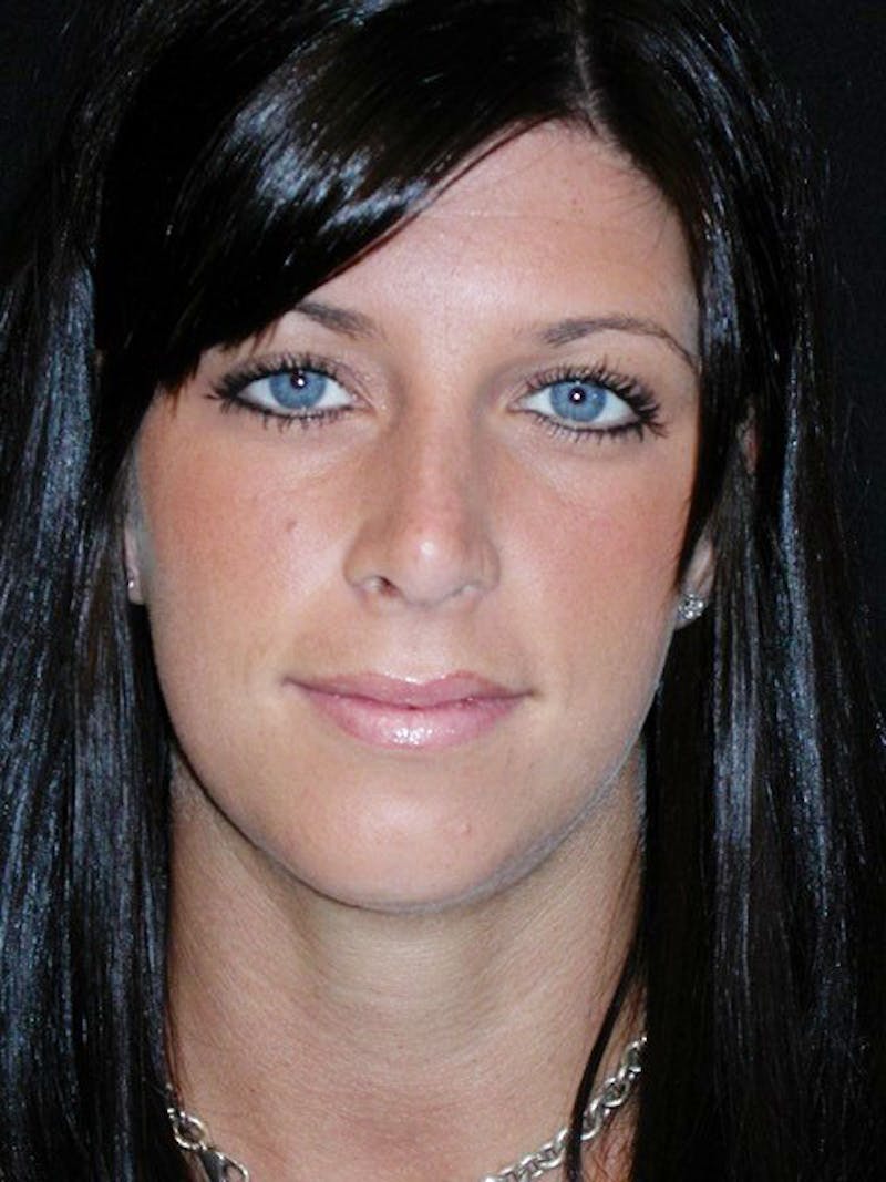 Rhinoplasty Before & After Gallery - Patient 100682 - Image 6