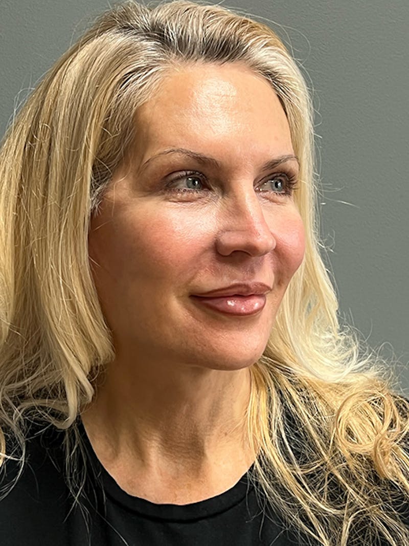 Deep Plane Facelift Before & After Gallery - Patient 260451 - Image 4