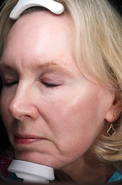 Lasers & Light Before & After Gallery - Patient 123276 - Image 2