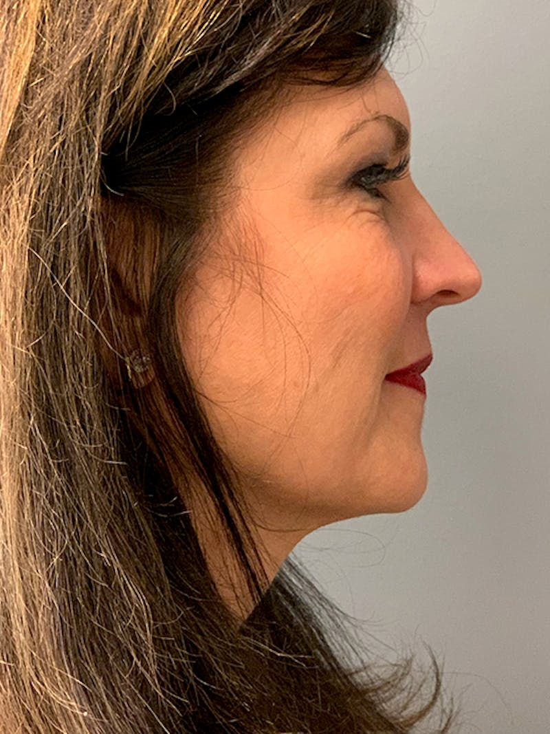 Deep Plane Facelift Before & After Gallery - Patient 260451 - Image 5
