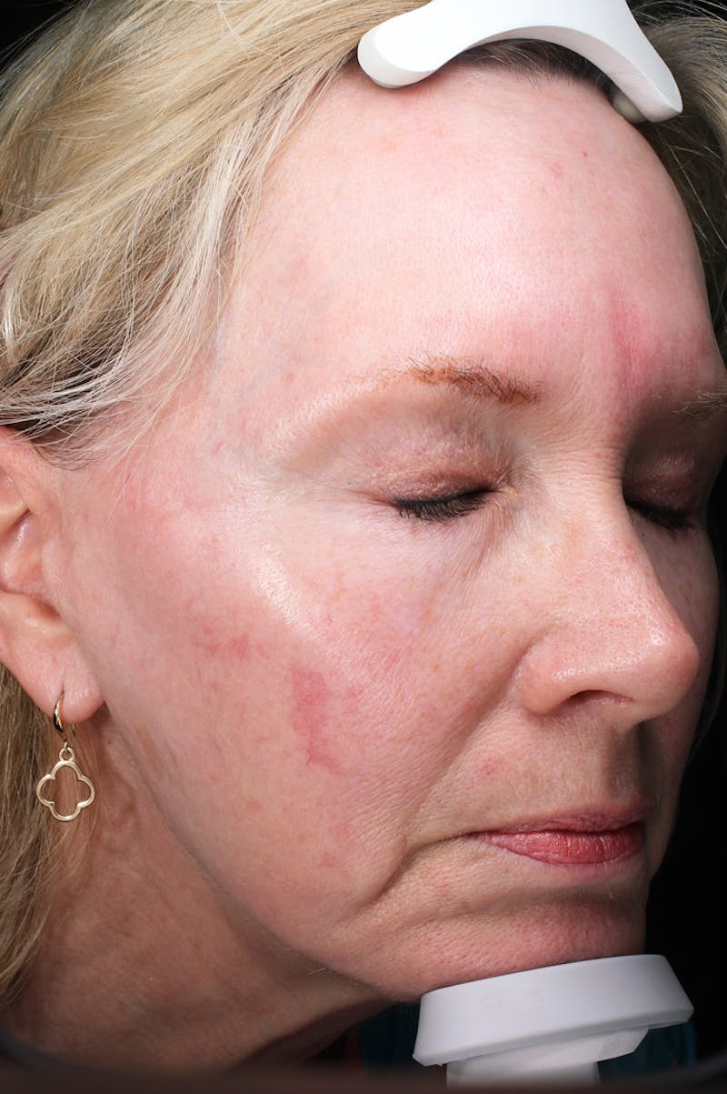 Lasers & Light Before & After Gallery - Patient 123276 - Image 3