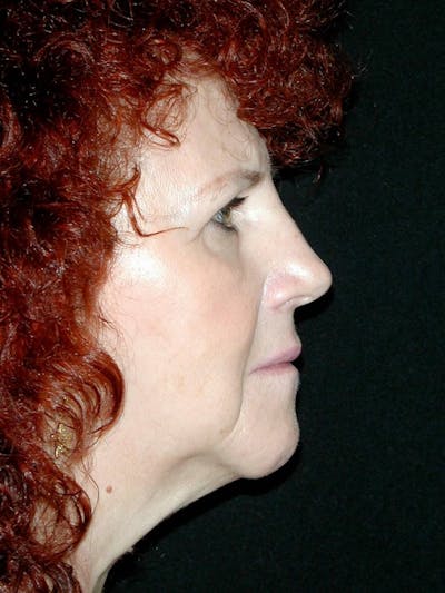 Rhinoplasty Before & After Gallery - Patient 375428 - Image 1