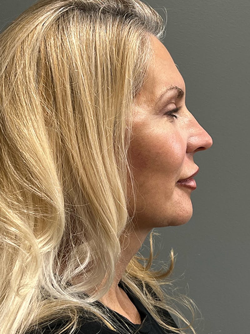 Deep Plane Facelift Before & After Gallery - Patient 260451 - Image 6
