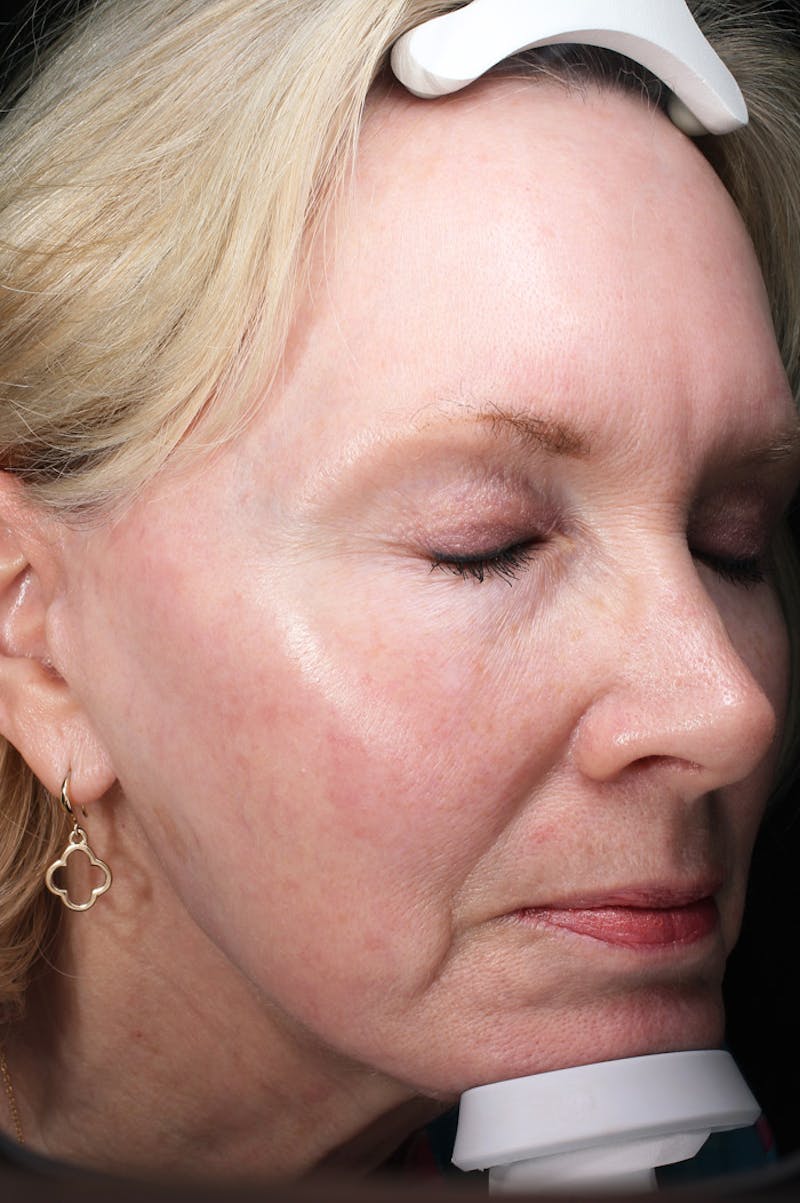 Lasers & Light Before & After Gallery - Patient 123276 - Image 4