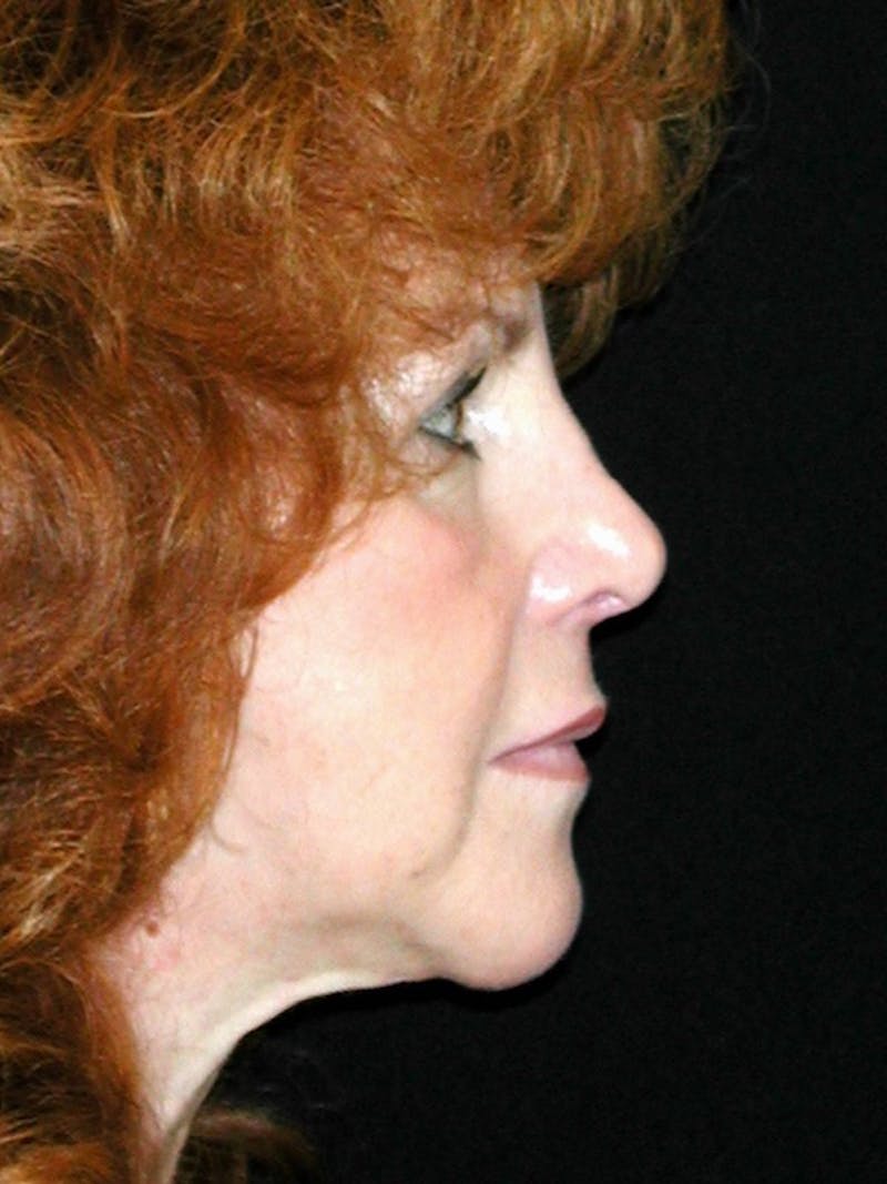 Rhinoplasty Before & After Gallery - Patient 375428 - Image 2