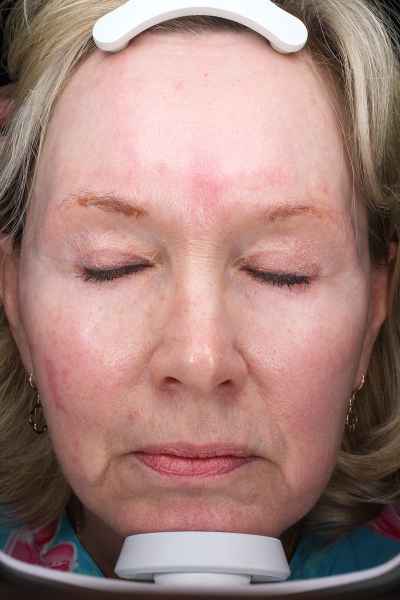 Lasers & Light Before & After Gallery - Patient 123276 - Image 5