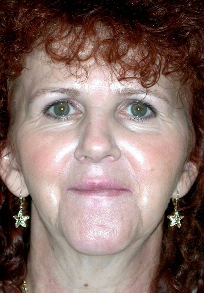 Rhinoplasty Before & After Gallery - Patient 375428 - Image 3