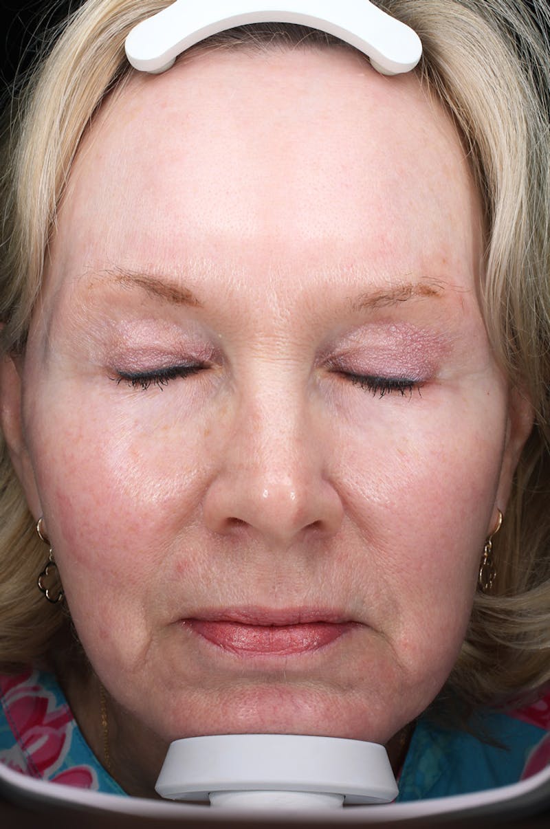 Lasers & Light Before & After Gallery - Patient 123276 - Image 6