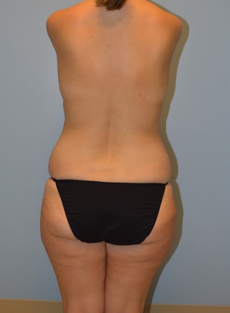 High Definition Mommy Makeover Before & After Gallery - Patient 254956 - Image 5