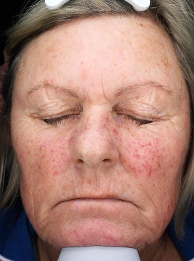 Lasers & Light Before & After Gallery - Patient 113536 - Image 1