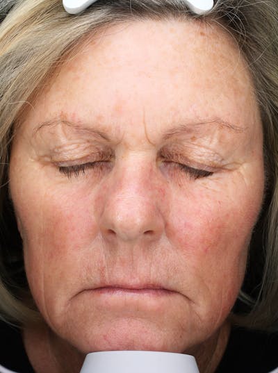 Lasers & Light Before & After Gallery - Patient 113536 - Image 2
