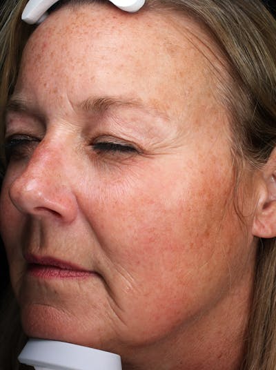 Lasers & Light Before & After Gallery - Patient 335546 - Image 1