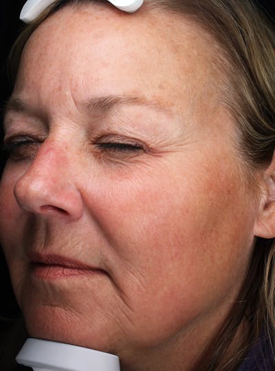 Lasers & Light Before & After Gallery - Patient 335546 - Image 2