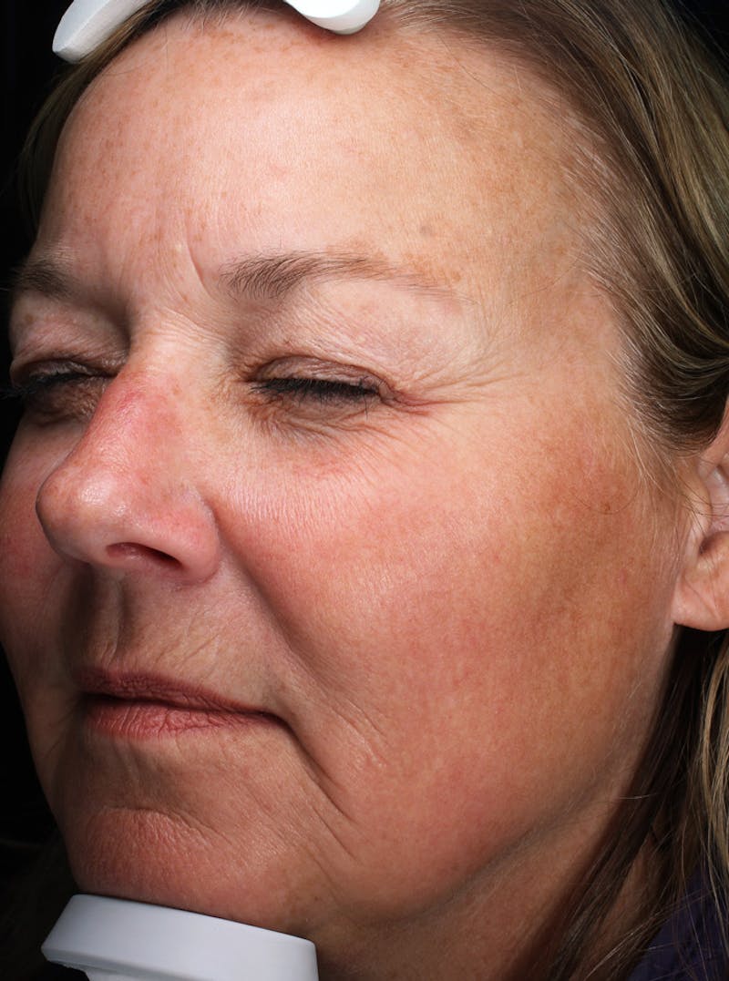 Lasers & Light Before & After Gallery - Patient 335546 - Image 2