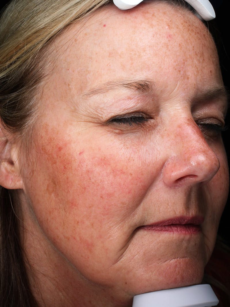 Lasers & Light Before & After Gallery - Patient 335546 - Image 3