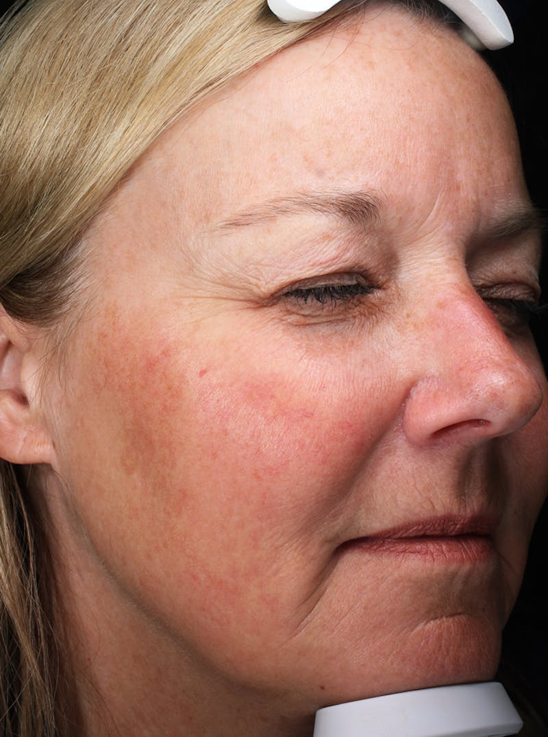 Lasers & Light Before & After Gallery - Patient 335546 - Image 4